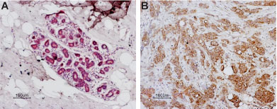 Expression of PAR-1 in normal human breast and human breast carcinoma
